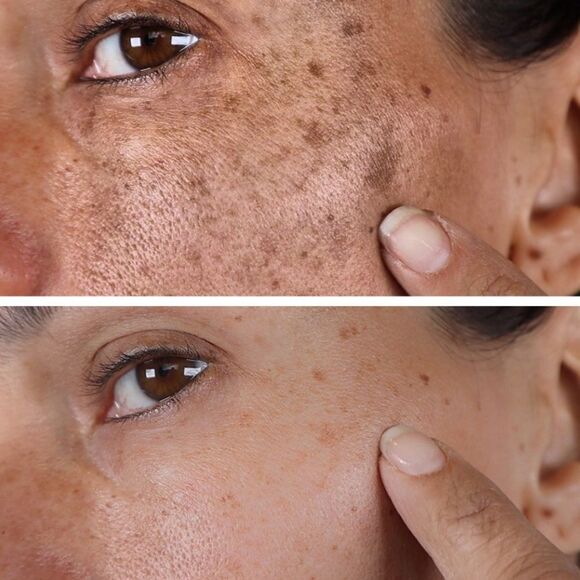 NIB CCHANS ADVANCED DARK SPOTS CORRECTOR FACE/BODY MINIMIZE SCARS/SKIN DAMAGE - Picture 7 of 14